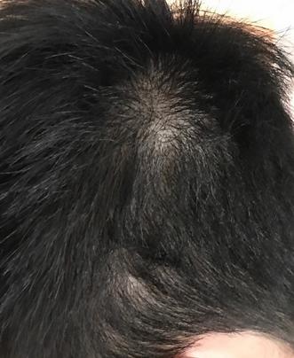 LOL西卡立志减肥当男神？可是秃头毁灭了他！